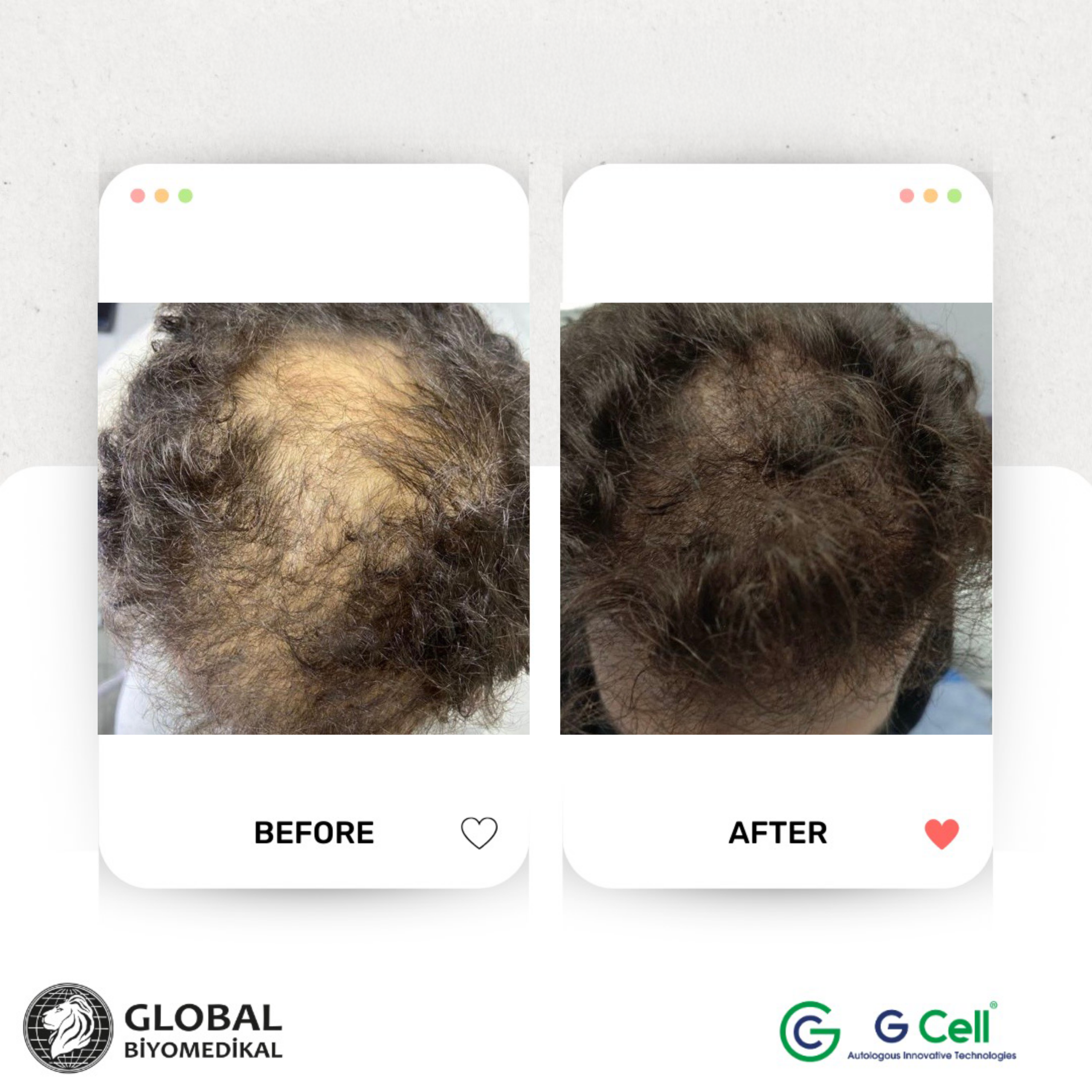 GBM_Before_After 1