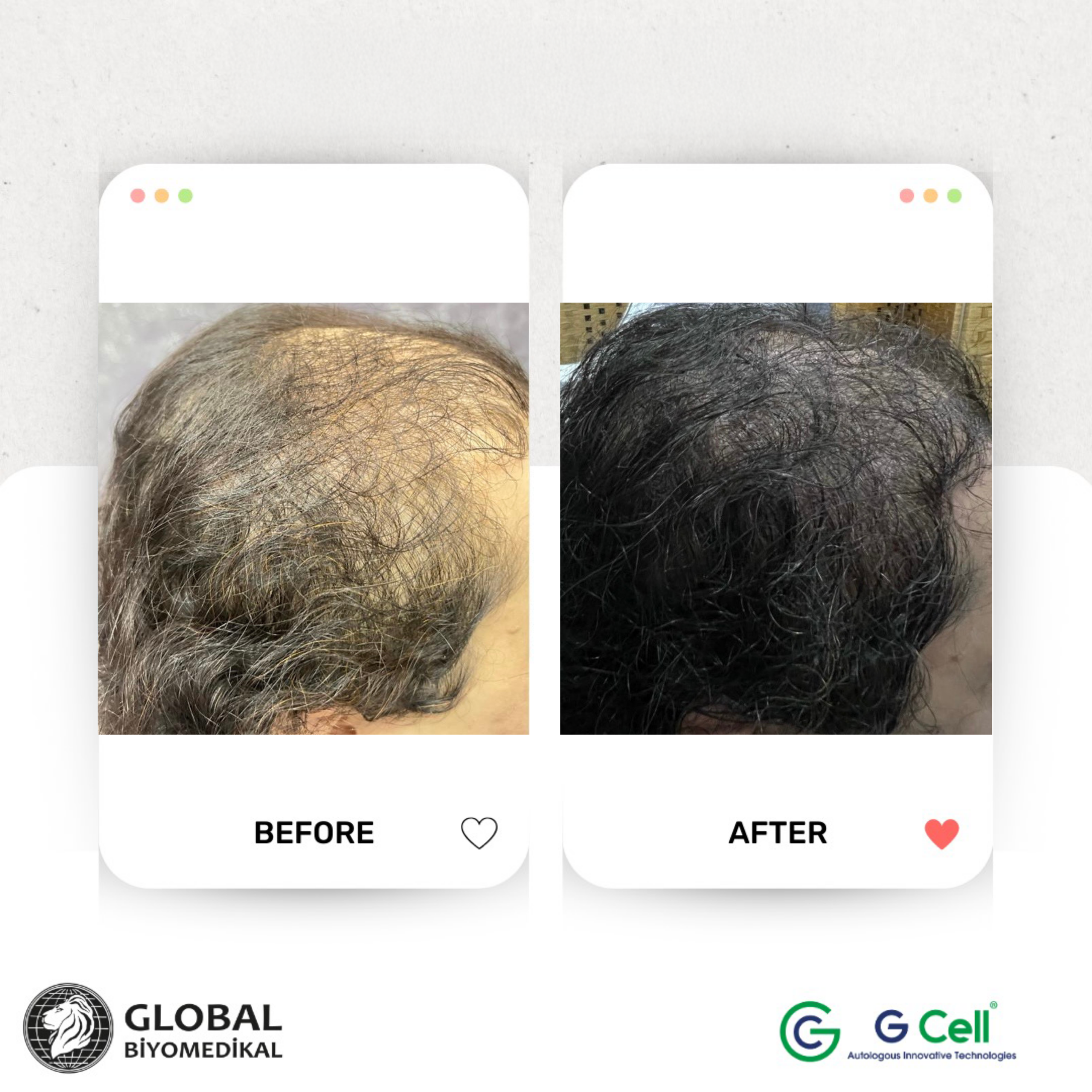 GBM_Before_After 3