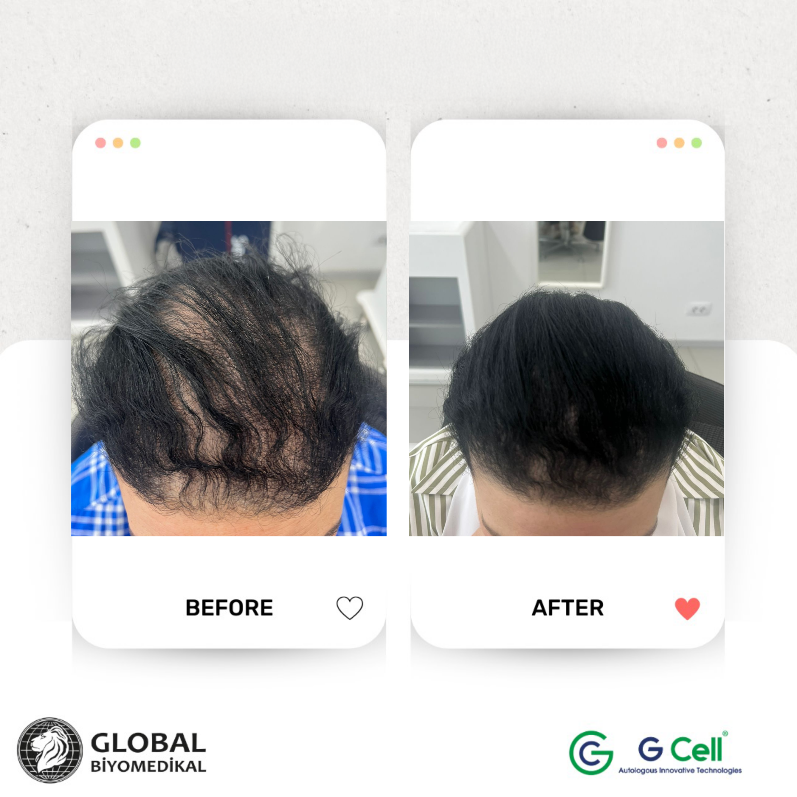 GBM_Before_After 5